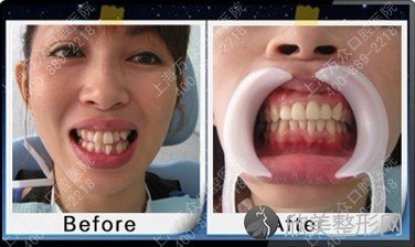 牙齿整形的合适年龄是大多吗？上海蓝生万众医院口腔科
